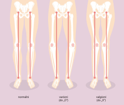 Hallux valgus