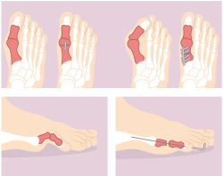 Hallux valgus