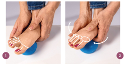 Hallux valgus